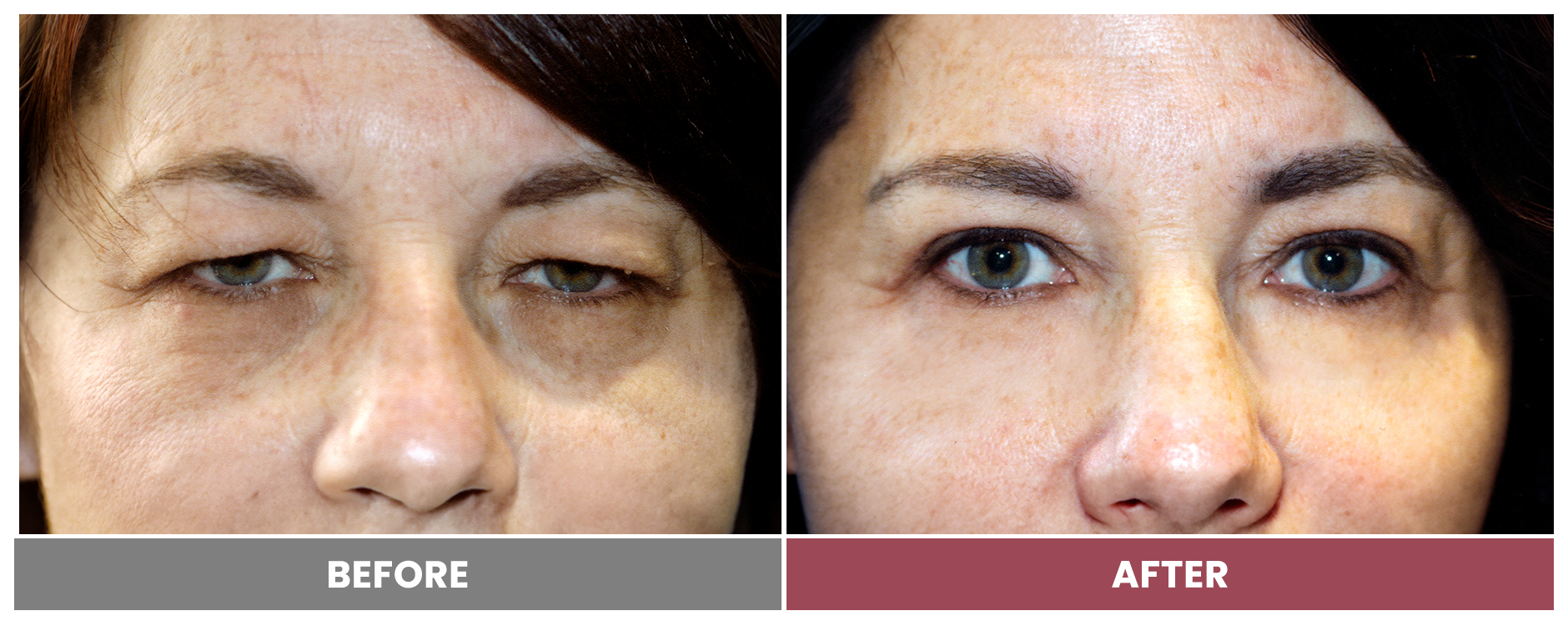 Upper Blepharoplasty - Case 87